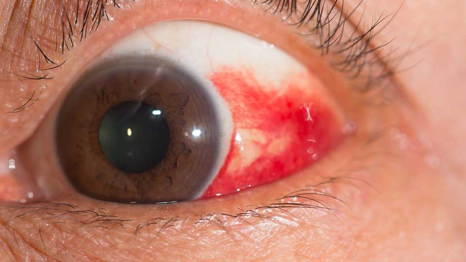 vaurioitunut silmän valkuainen